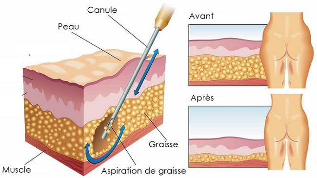 Liposuzione con doctour