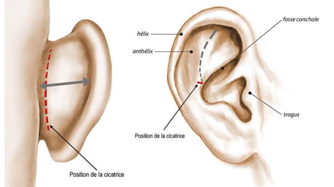 Otoplastica costi