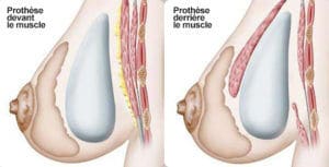 augmentation mammaire