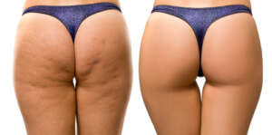 brazilian butt lift plastic surgery cost