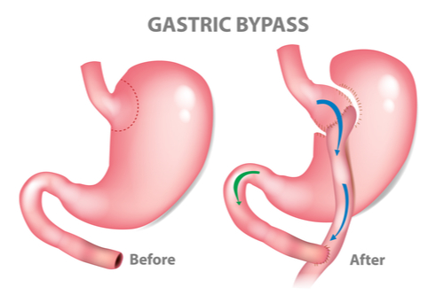 bypass gastrico